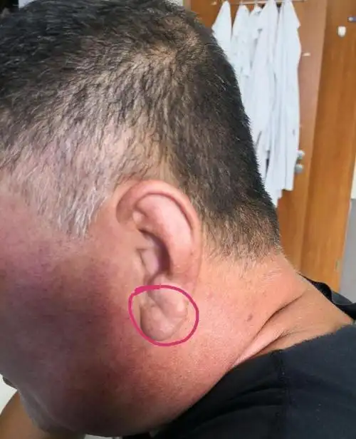 辟谣耳垂有褶皱预示冠心病医生一个没有太多价值的说法