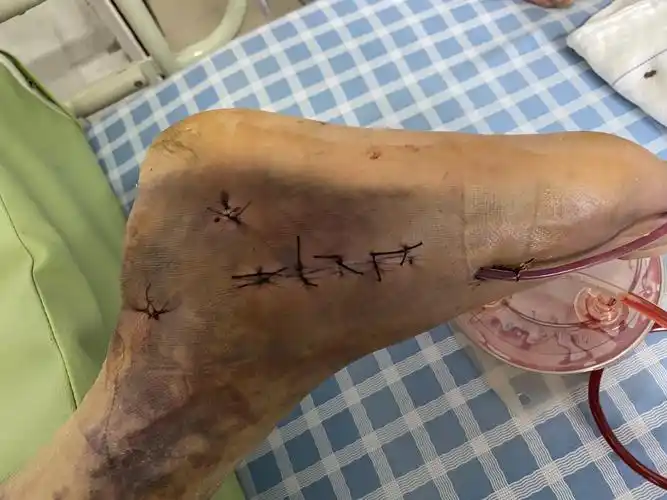 一例跟骨骨折微创治疗分享