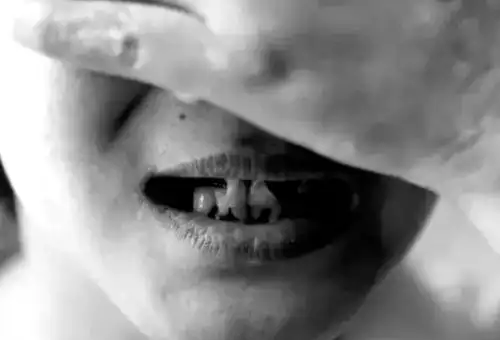 每吸食一次冰毒,人的大脑皮层就会形成一处水泡,水泡破裂后,就形成了