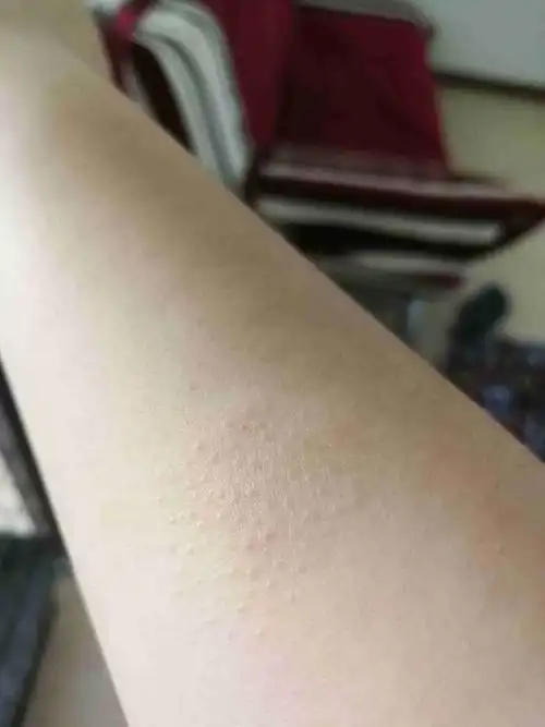 胳膊上涨了一堆小疙瘩,不疼不痒的