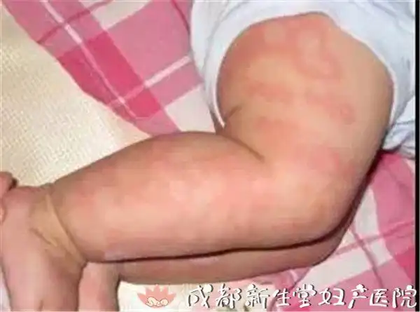 晨晨被紧急送往温医大附属育英儿童医院进行抢救,被诊断为 荨麻疹和