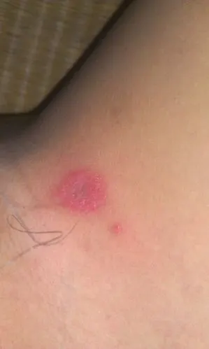 大腿内侧长了个红疙瘩