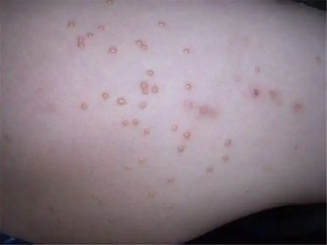 传染性软疣成熟的图片_有来医生