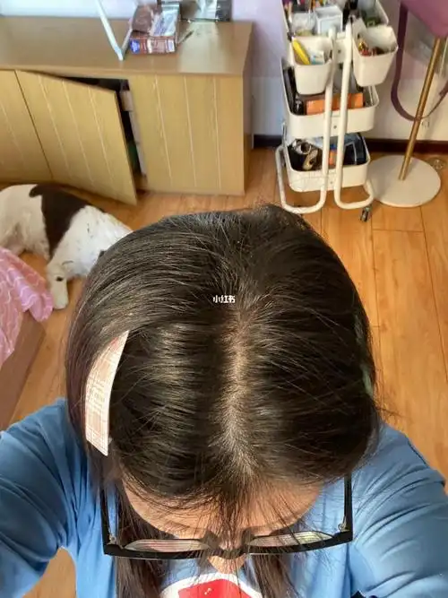 26岁这个发缝正常吗