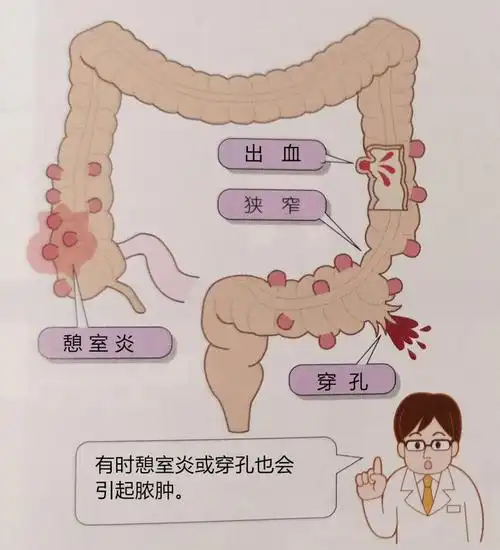 消化道憩室2 - 我的网站