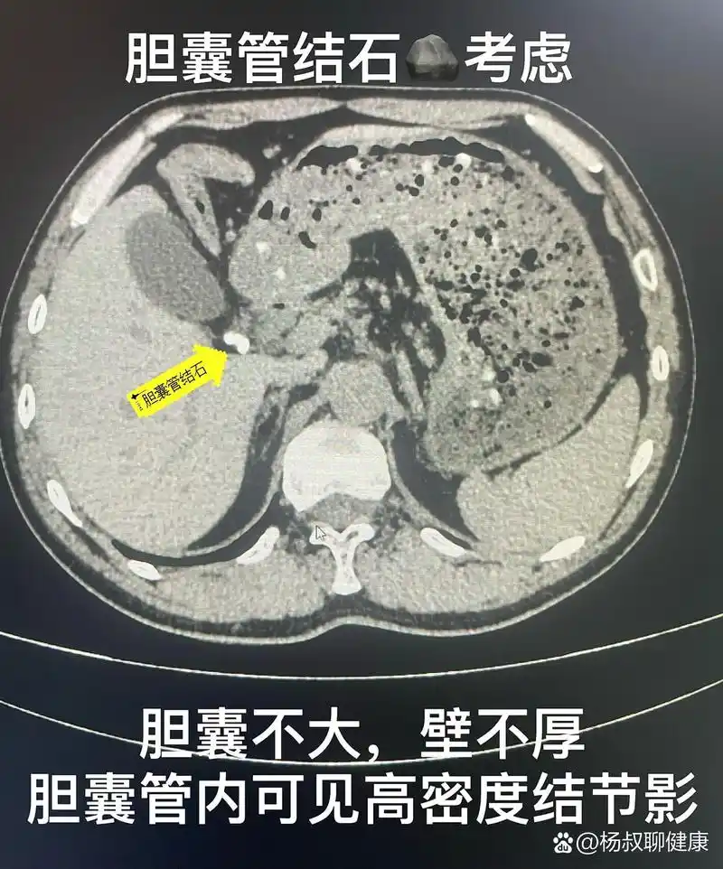 胆系结石的ct表现💕💕💕 	 平扫:根据其化学成分不同,胆结石在