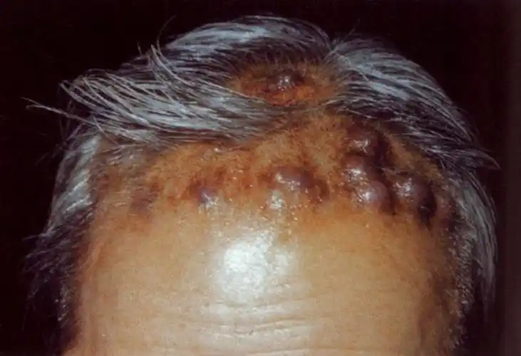 淋巴癌图片_淋巴癌症状表现图片大全_有来医生