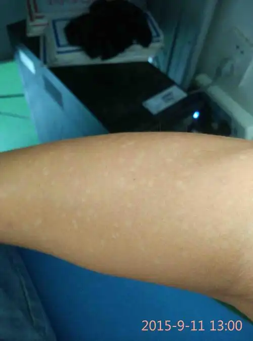 汗斑【多图】_39医疗图集-39健康网