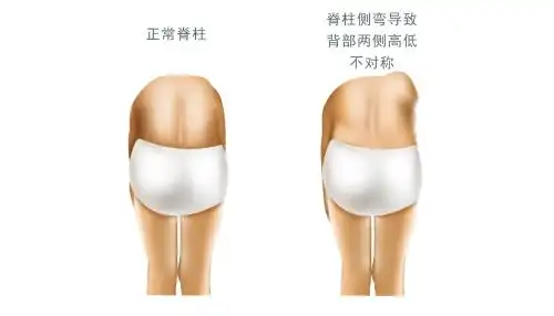 脊柱侧弯对比图