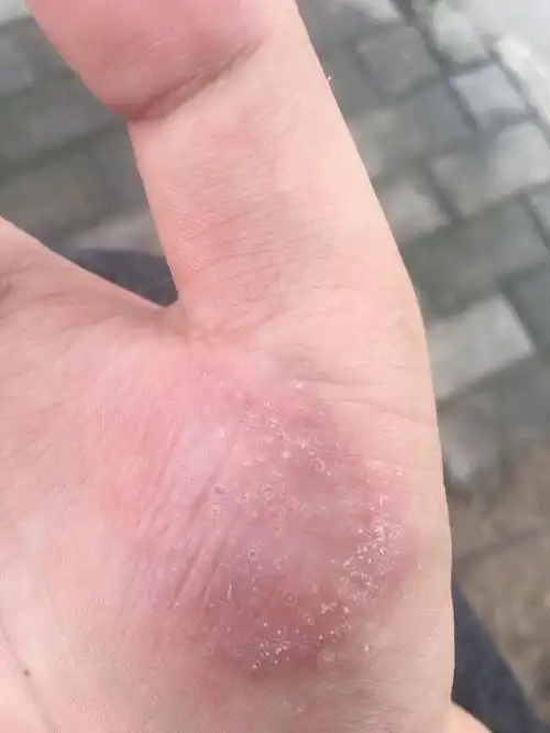 这是鹅掌风吗?到夏天的时候就会痒 还起水泡