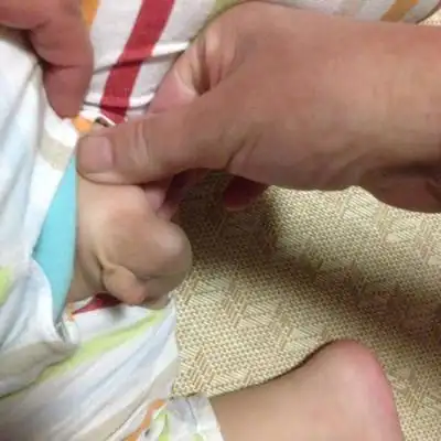 亲们,昨天给儿子洗澡,突然发现儿子泡泡多了一个软软的"蛋蛋",仔细摸