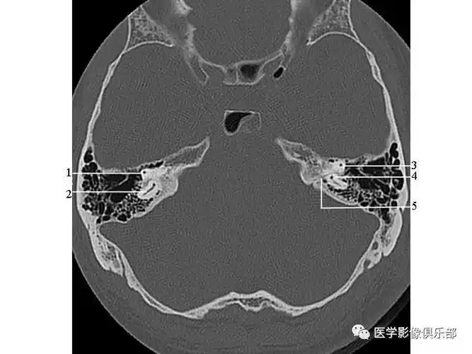颞骨正常ct解剖