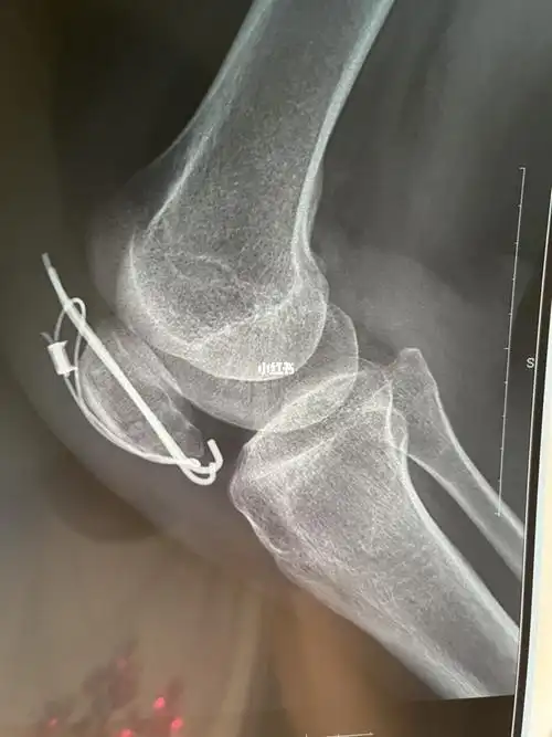 髌骨骨折术后第56天第二次复查