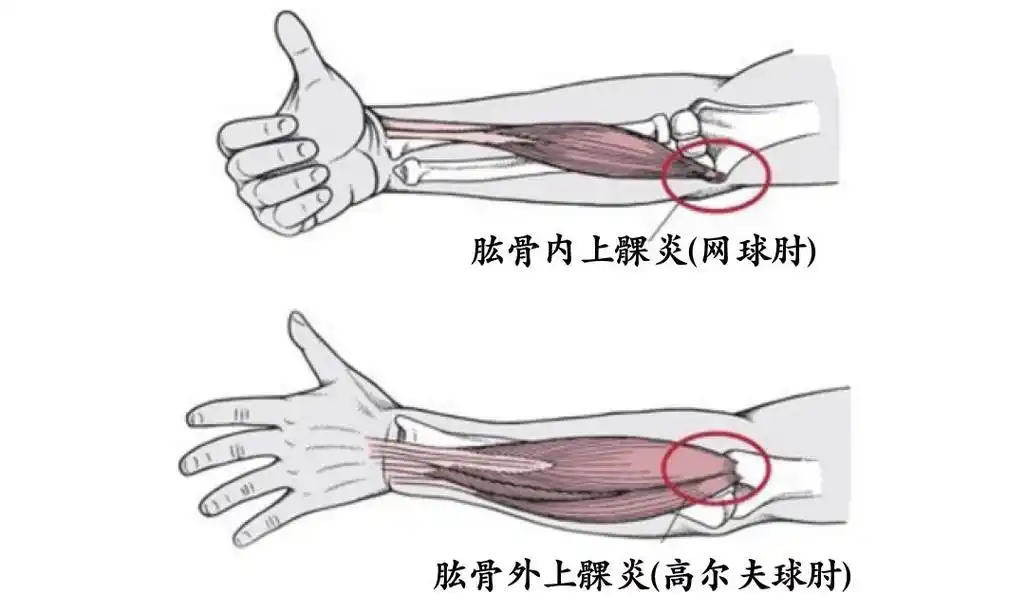 为什么我不打网球会得"网球肘"?该怎么办?