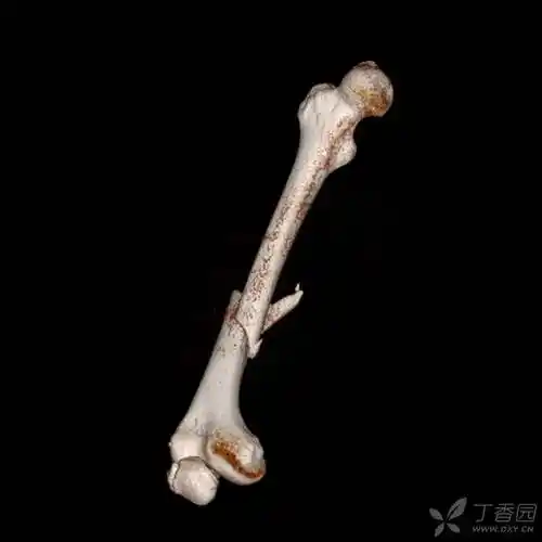 易误诊的二分髌骨 - 丁香园论坛