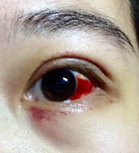 眼睛红了一块是怎么回事