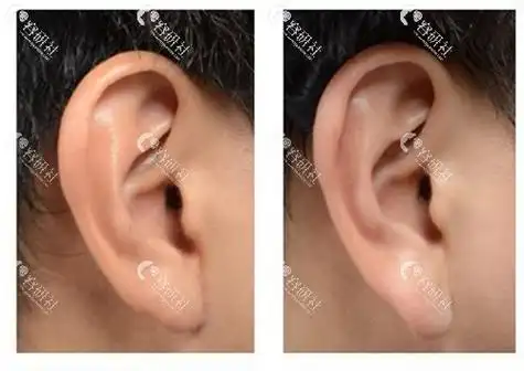 玻尿酸丰耳垂危险吗?术后会不会导致栓塞?