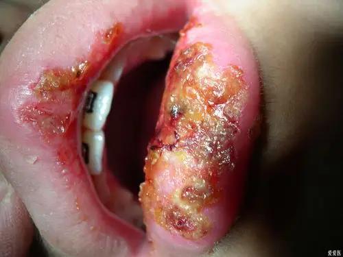这个是什么粘膜病? - 口腔医学专业讨论版 - 爱爱医医学论坛