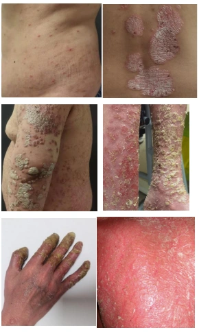 银屑病可以分为寻常型,斑块型,脓疱型,关节病型,红皮病型.2.分类1.