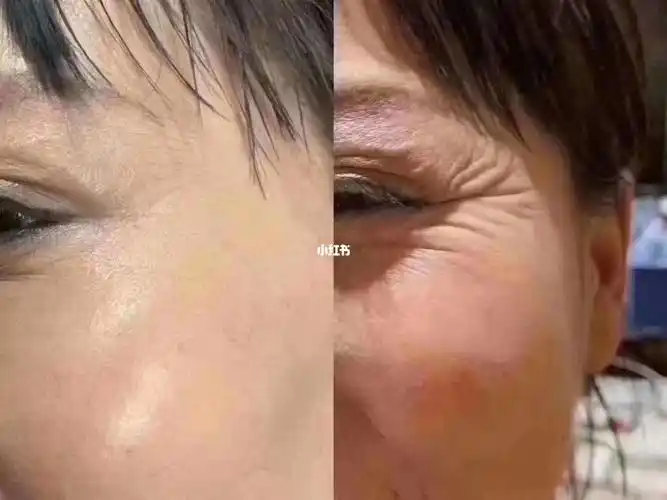 能弹走鱼尾纹还是除皱针来的实在