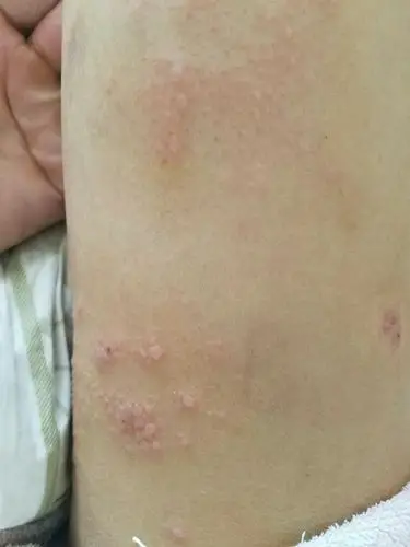 家人腿上起了水泡 疙瘩