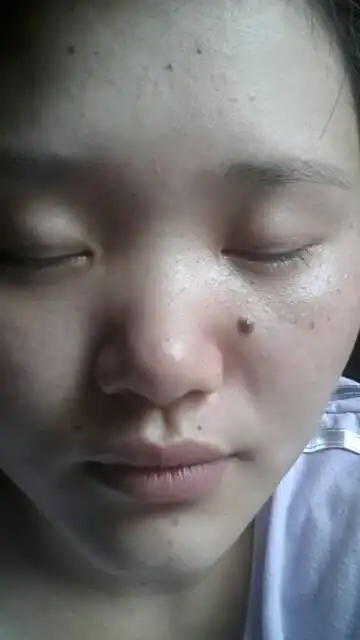 请问我脸上这颗大黑痣可以去掉吗?会不会留疤痕