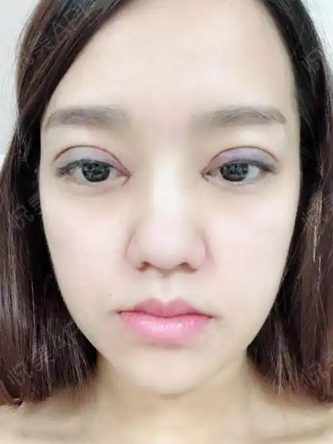 割双眼皮后修复的图片,全切双眼皮一周的照片恢复过程