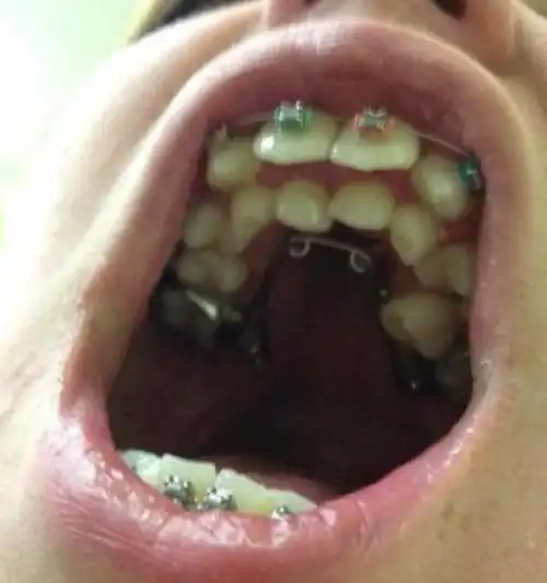 8岁小孩长出畸形双排牙, 牙医说都是父母的错|163_手机网易网