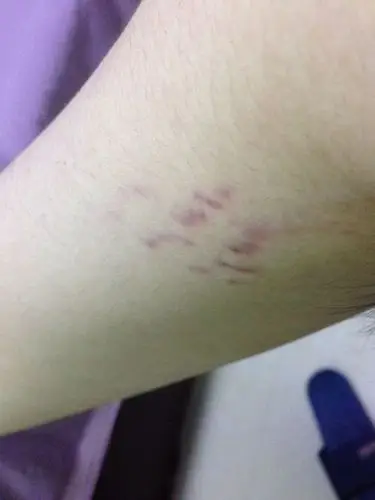 这个腋窝下的红斑是怎么回事?