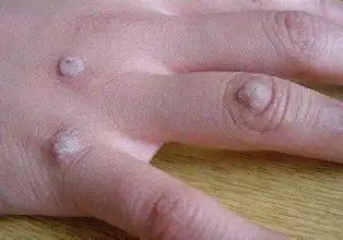 瘊子的治疗方法