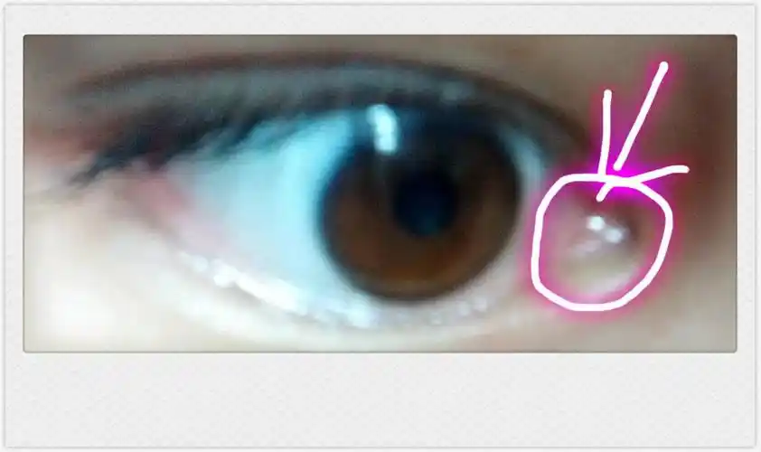 内眼角里接近鼻翼的小肉肉上长了许多的黄色小粒,是怎么回事啊,急求解