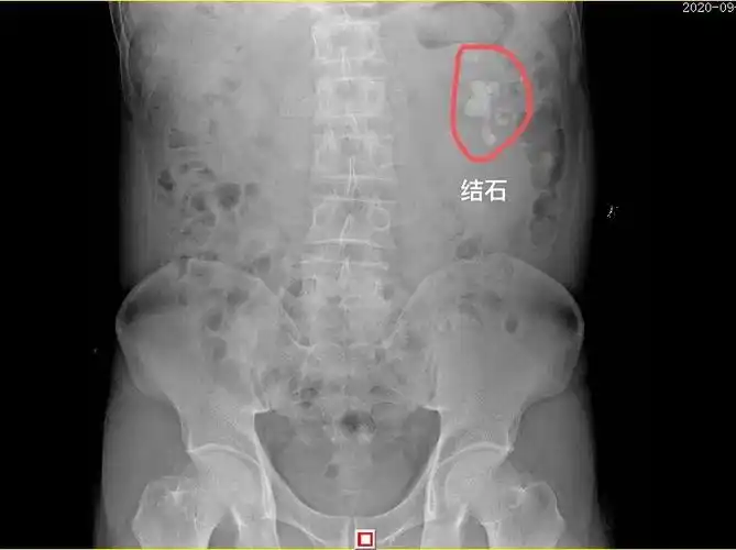 又酿惨剧:赣州男子肾结石治疗不当被耽误致左肾坏死_手机搜狐网