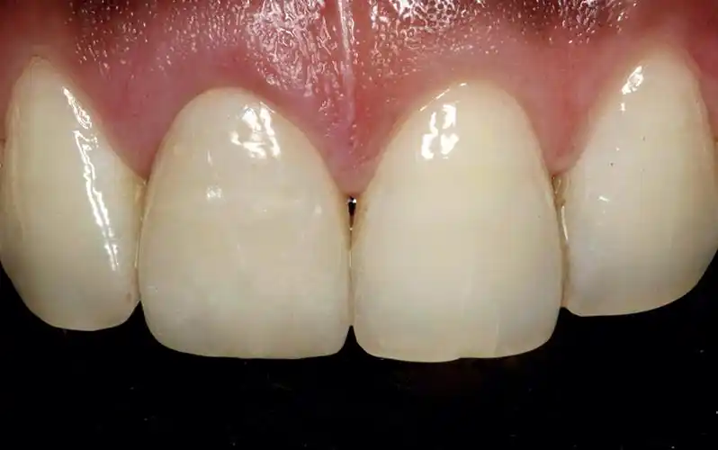 单冠全瓷牙修复