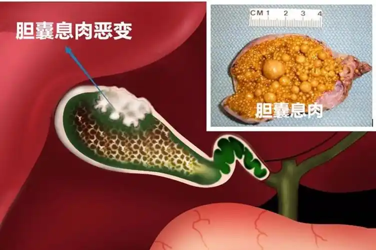 胆囊息肉怎么才能消除