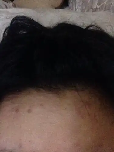 皮肤是油性的 这么祛痘_百度知道