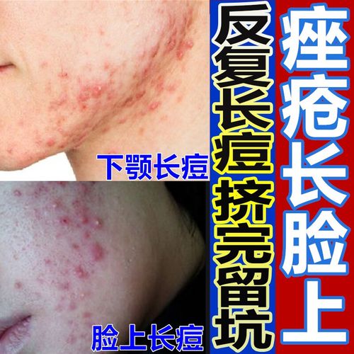 去看脸上长痘痘的药痤疮膏 痘痘 脓疱疮粉刺闭口毛囊炎脓包痤疮毛囊炎