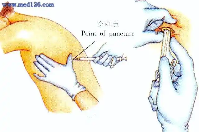 穿刺针进入胸膜腔时,可有明显的突破感(图8).