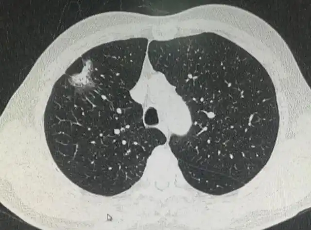 查出肺结节,怎么确定是不是恶性结节?