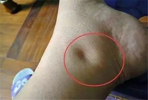 脚上有这4个症状, "癌细胞"可能盯上你了!荣格牌壳聚糖有一套