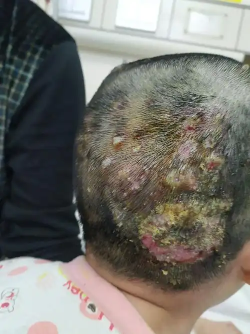 小孩子头皮长脓包是怎么回事
