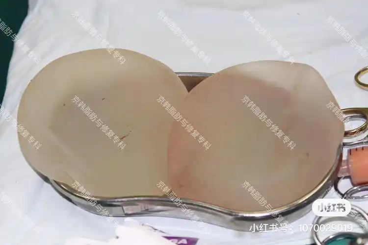 在胸部十几年的#胸假体##取出即刻是什么样子?