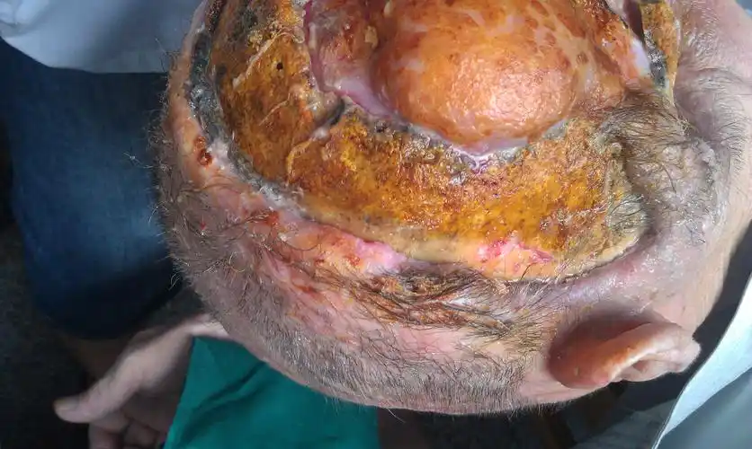 求治疗方案——全国首例基底细胞癌