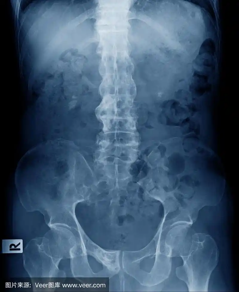 强直性脊柱炎,脊柱,x光片,老年男人,竹子