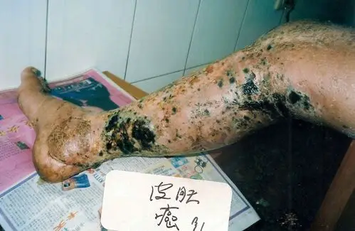 淋巴癌图片_淋巴癌症状表现图片大全_有来医生