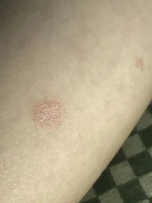 小红疙瘩,大人看的心里着急,去皮肤医院检查了以后说是常见性银屑病