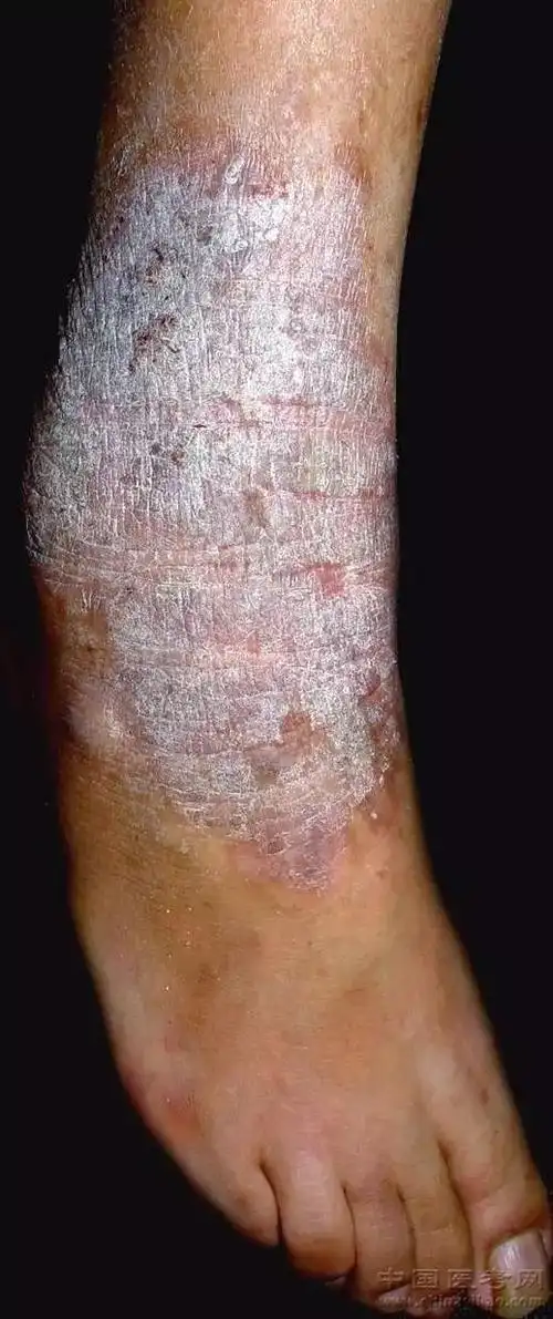 史上最全的皮肤病图谱来了