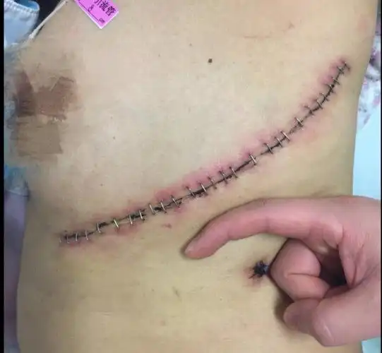 单孔胸腔镜——肺结节,肺癌等胸部疾病患者的福音!