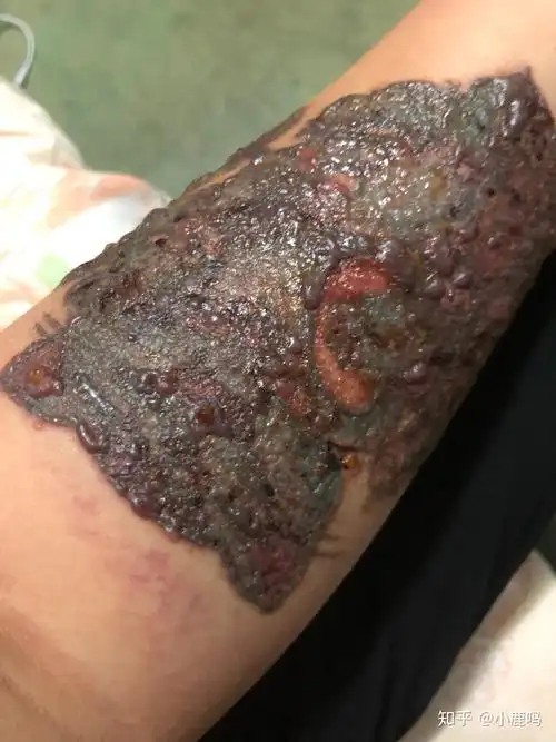 激光洗纹身第二次