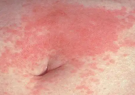 初期红皮型银屑病图片症状红色皮疹