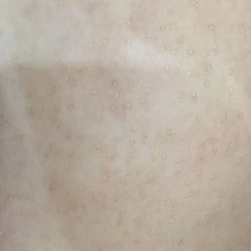 肚子上长了这么多芝麻一样的小痘痘是什么?